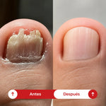 Parches MicoDerm®